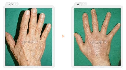 Stem Cell Fat Graft - Fat graft - hands