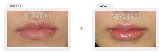 	Stem Cell Fat Graft	 - Fat graft - lips