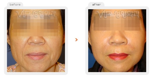 Face Lift - Wrinkle improvement surgery