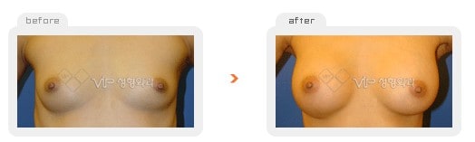 	Breast Surgery	 - Breast augmentation