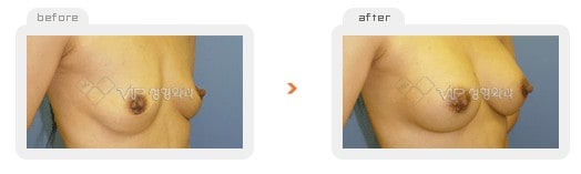 	Breast Surgery	 - Breast augmentation