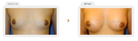 	Breast Surgery	 - Breast augmentation