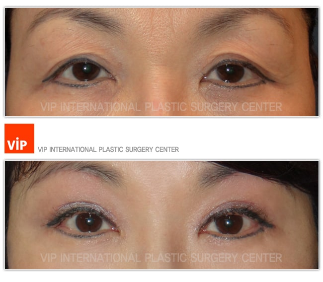 	Eye Surgery, Double Fold, Ptosis Correction	 - Brow lift