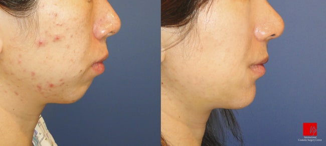 	Facial Bone Surgery	 - Genioplasty