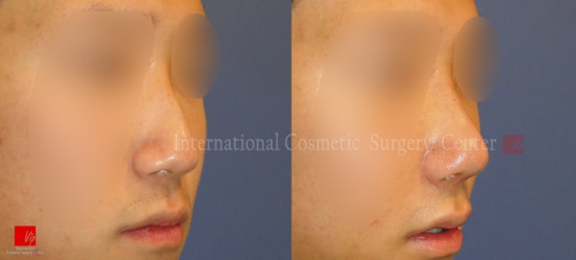 	Nose Surgery, Harmony-Rhinoplasty, Each Cases Nose, Septal Deviation	 - Septal deviation