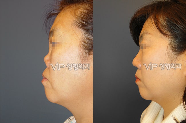 	Protruded Mouth Correction Rhinoplasty, Rib cartilage Rhinoplasty, Contracted Nose, Revision Rhinoplasty, Each Cases Nose	 - Revision rhinoplasty with Rib cartilage -Collapsed by silicone implant