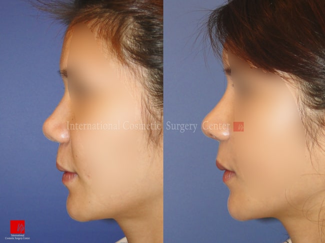 	Nose Surgery, Harmony-Rhinoplasty, Each Cases Nose	 - Harmony face surgery