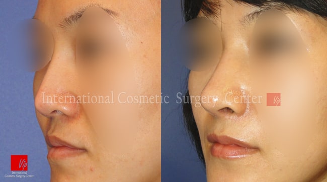 	Harmony-Rhinoplasty, Protruded Mouth Correction Rhinoplasty, Rib cartilage Rhinoplasty, Revision Rhinoplasty, Septal Deviation	 - Revision rhinoplasty using Rib cartilage