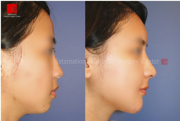 	Nose Surgery, Rib cartilage Rhinoplasty, Stem Cell Fat Graft	 - Autologous Rhinoplasty and Fat graft