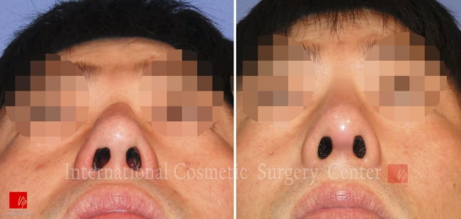 	Protruded Mouth Correction Rhinoplasty, Contracted Nose, Revision Rhinoplasty	 - 2nd Op. - Rib cartilage rhinoplasty