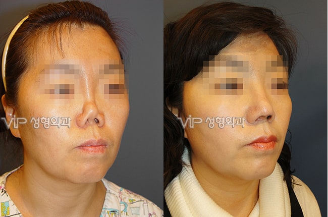 	Protruded Mouth Correction Rhinoplasty, Rib cartilage Rhinoplasty, Contracted Nose, Revision Rhinoplasty, Each Cases Nose	 - Revision rhinoplasty with Rib cartilage -Collapsed by silicone implant