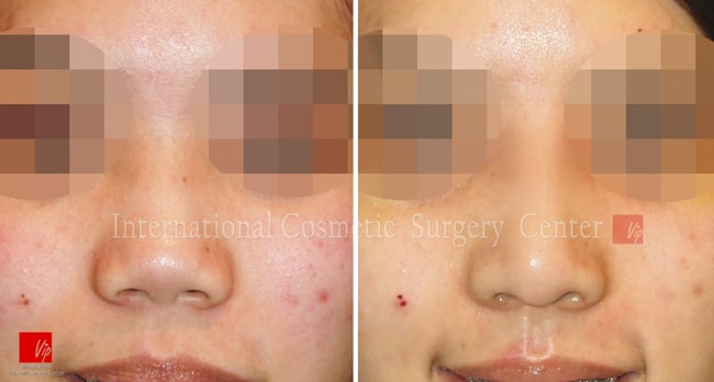 	Nose Surgery, Harmony-Rhinoplasty, Rib cartilage Rhinoplasty	 - Correction of protruded mouth with Harmony rhinoplasty