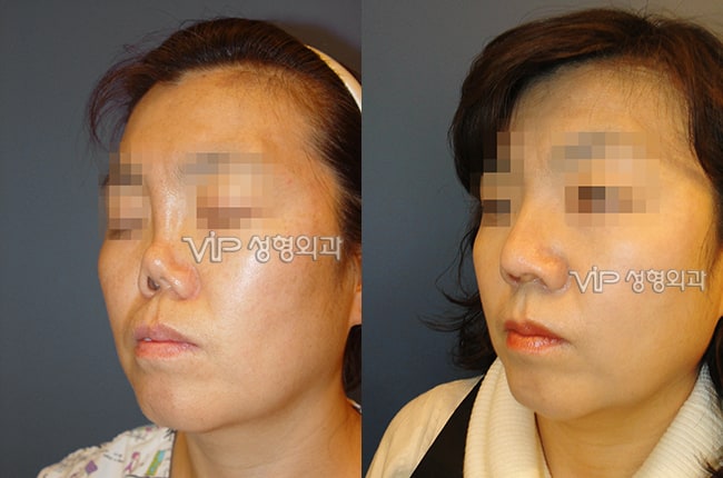 	Protruded Mouth Correction Rhinoplasty, Rib cartilage Rhinoplasty, Contracted Nose, Revision Rhinoplasty, Each Cases Nose	 - Revision rhinoplasty with Rib cartilage -Collapsed by silicone implant