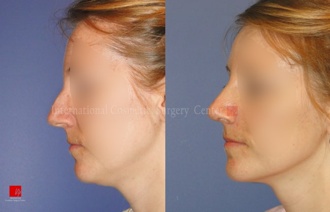 	Nose Surgery, Harmony-Rhinoplasty, Each Cases Nose	 - Septal deviation, humped nose correction