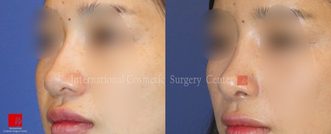 	Harmony-Rhinoplasty, Protruded Mouth Correction Rhinoplasty, Rib cartilage Rhinoplasty, Revision Rhinoplasty, Septal Deviation	 - Septal deviation with mid face retrusion