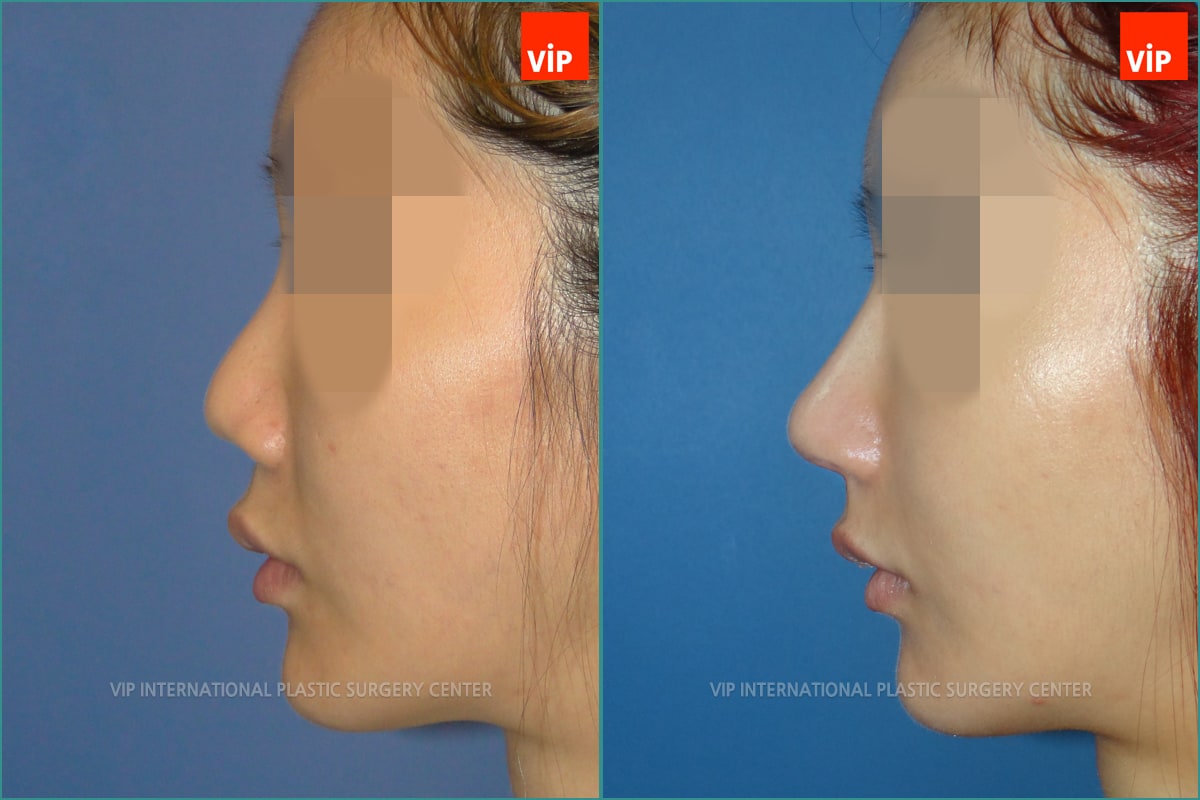 	Nose Surgery, Rib cartilage Rhinoplasty, Contracted Nose, Each Cases Nose	 - Rib cartilage Rhinoplasty