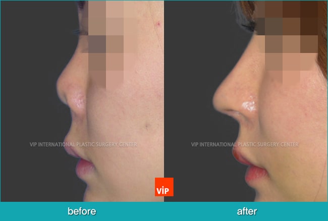 	Nose Surgery, Rib cartilage Rhinoplasty, Contracted Nose, Revision Rhinoplasty	 - Post infection contracted nose correction with rib cartilage rhinoplasty