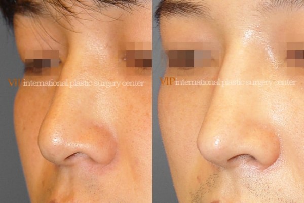 Nose Surgery - Septal deviation correction