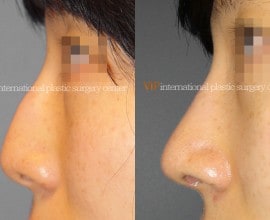 Nose bridge correction