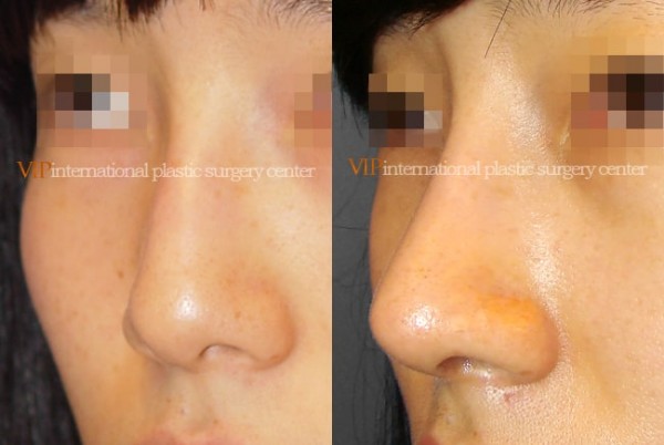 Nose Surgery - Nose bridge correction