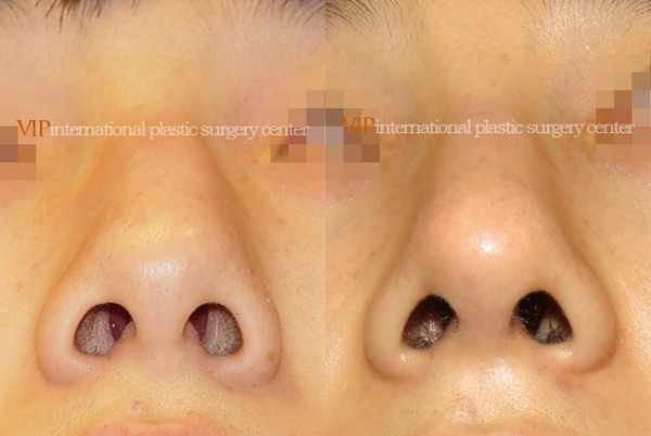 Nose Surgery - Nose bridge correction