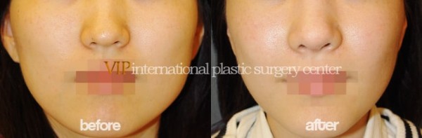 Facial Bone Surgery - Zygoma reduction