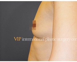 Breast surgery