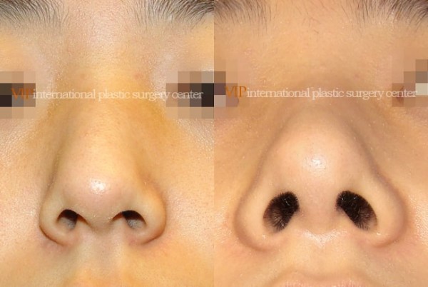 Nose Surgery - Nose bridge correction