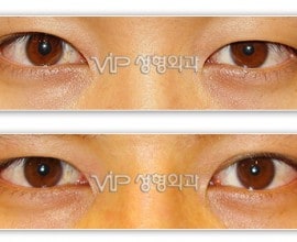 Double eyelid surgery