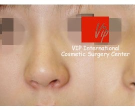 Autologous rhinoplasty