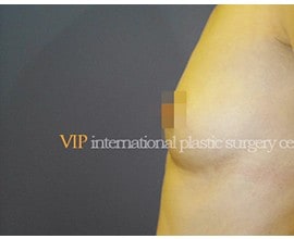 Breast surgery