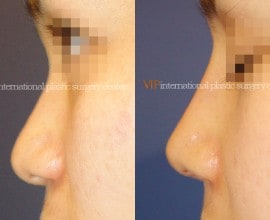 Rhinoplasty