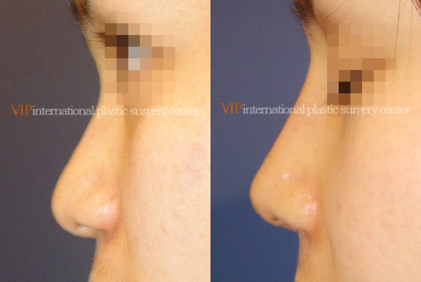 Nose Surgery - Rhinoplasty