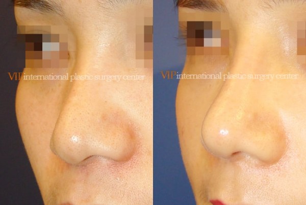 Nose Surgery - Rhinoplasty