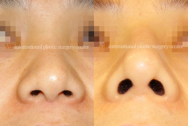 Nose Surgery - Rhinoplasty