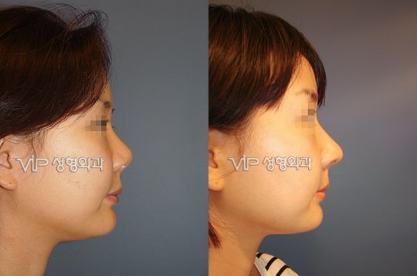 	Nose Surgery, Rib cartilage Rhinoplasty, Revision Rhinoplasty	 - Contraction due to silicone - Revision with Rib cartilage rhinoplasty