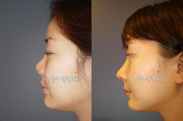 	Nose Surgery, Rib cartilage Rhinoplasty, Revision Rhinoplasty	 - Contraction due to silicone - Revision with Rib cartilage rhinoplasty