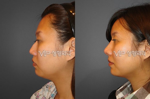 	Nose Surgery, Rib cartilage Rhinoplasty, Revision Rhinoplasty	 - Septal cartilage rhinoplasty