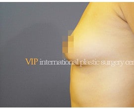 Breast surgery