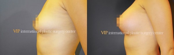 Breast Surgery - Breast surgery