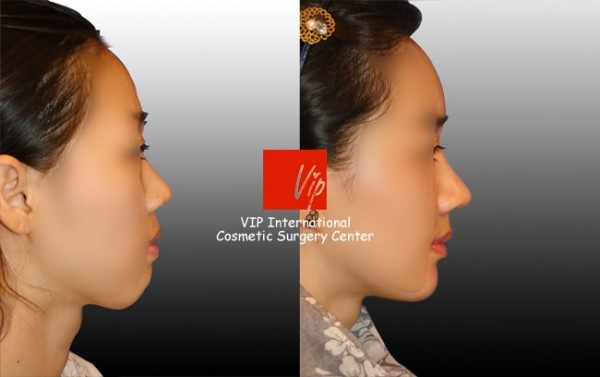 	Harmony-Rhinoplasty, Protruded Mouth Correction Rhinoplasty, Rib cartilage Rhinoplasty	 - Harmony rhinoplasty