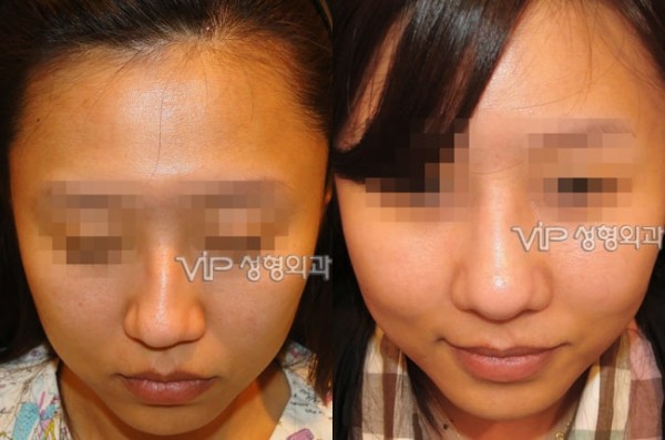 	Nose Surgery, Rib cartilage Rhinoplasty, Revision Rhinoplasty	 - Septal cartilage rhinoplasty