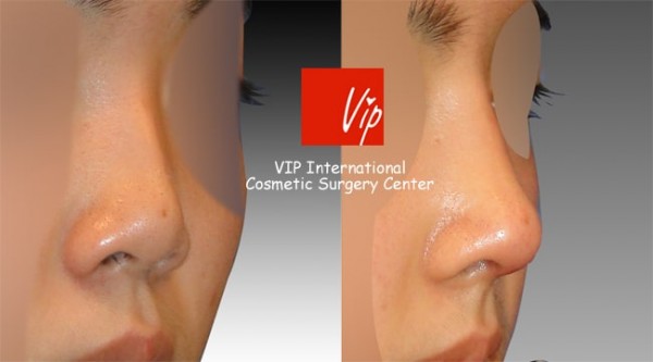 	Nose Surgery, Rib cartilage Rhinoplasty, Each Cases Nose	 - Short & Flat nose - Rib cartilage rhinoplasty