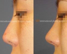 Silicone infected nose revision
