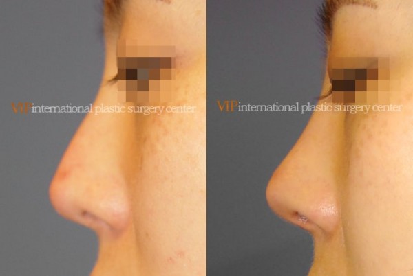 Nose Surgery - Silicone infected nose revision