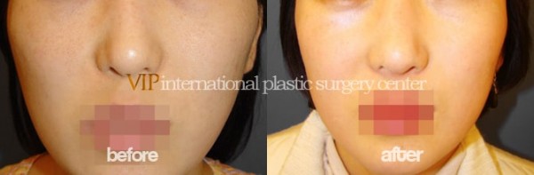 Facial Bone Surgery - Zygoma reduction