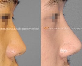 Rhinoplasty