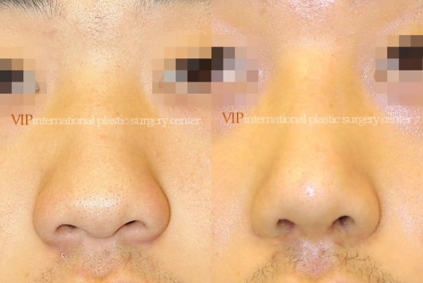 Nose Surgery - Rhinoplasty