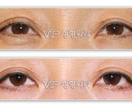 Lower blepharoplasty