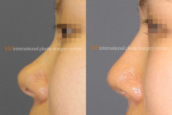 Nose Surgery - Bulbous nose rhinoplasty